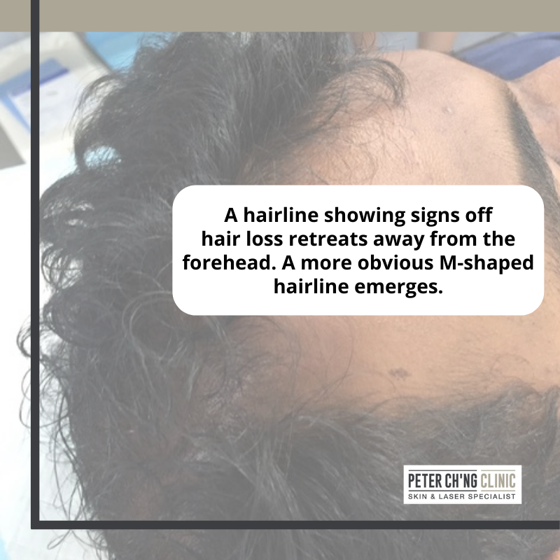 How Do I Know If I’m Losing My Hair? 4 Signs of Hair Loss Peter Ch'ng